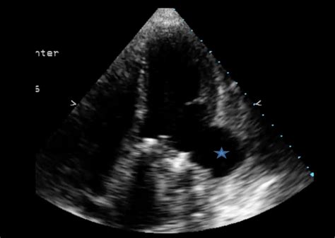 lv aneurysm vs pseudoaneurysm echo|pseudoaneurysm risk factors.